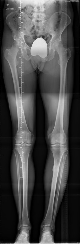 Frattura composta di tibia e perone