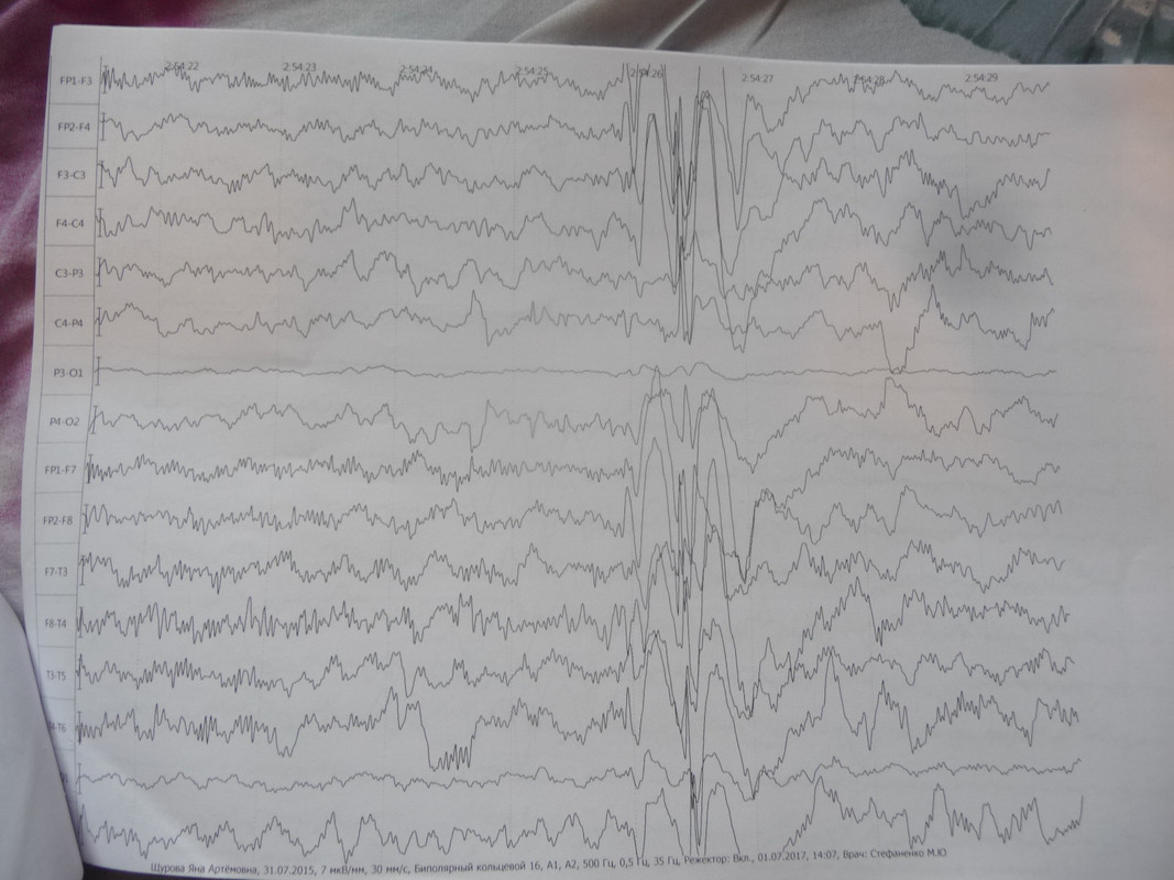 Эпиактивность. Эпиактивность энцефалограмма. Эпиактивность на ЭЭГ. Эпиактивность на ЭЭГ без приступов.